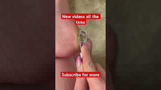 #feet #footcallusremoval #callusremoval #asmr #foot #callus #goddess #peeling