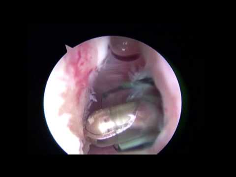 Arthroscopic Anterior Labral Repair with Remplissage