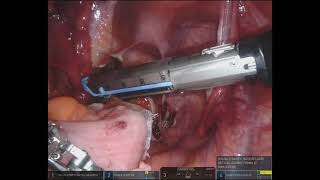 Download Lagu Robotic Frykman-Goldberg procedure for complete rectal prolapse – A video vignette Thumbnail