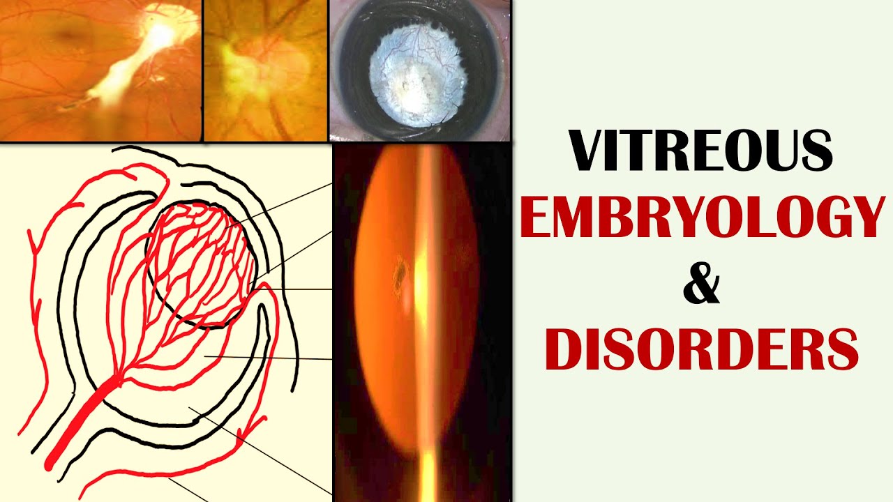 Development of Eye (Primary, Secondary and Tertiary Vitreous) and its Disorders