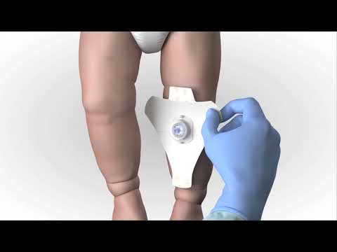 Arrow® EZ IO® System   Proximal Tibia Site Identification Insertion Infant Child, Animation