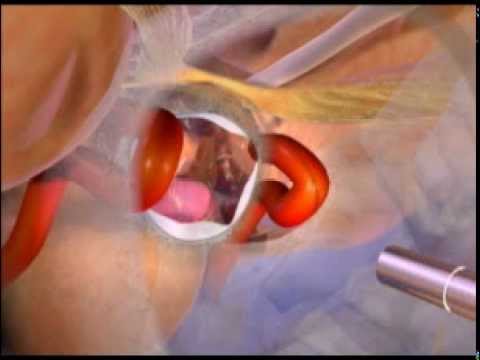 Dr. Hrayr Shahinian Presents Endoscopic Endonasal Procedure