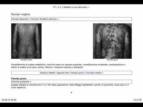 Crema di akrustat da psoriasi il prezzo Influenza di neurodermatitis su sistema nervoso