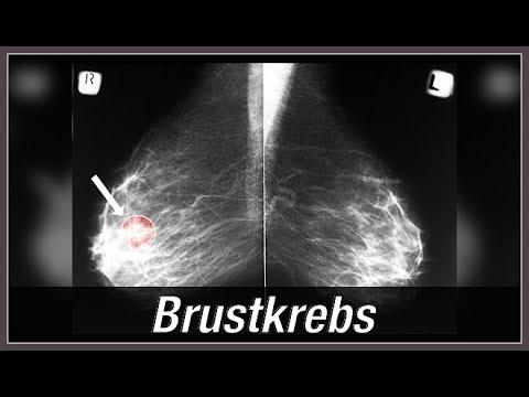 Gitt Video Übungen für die Gelenke Angriff Osteochondrose Temperatur