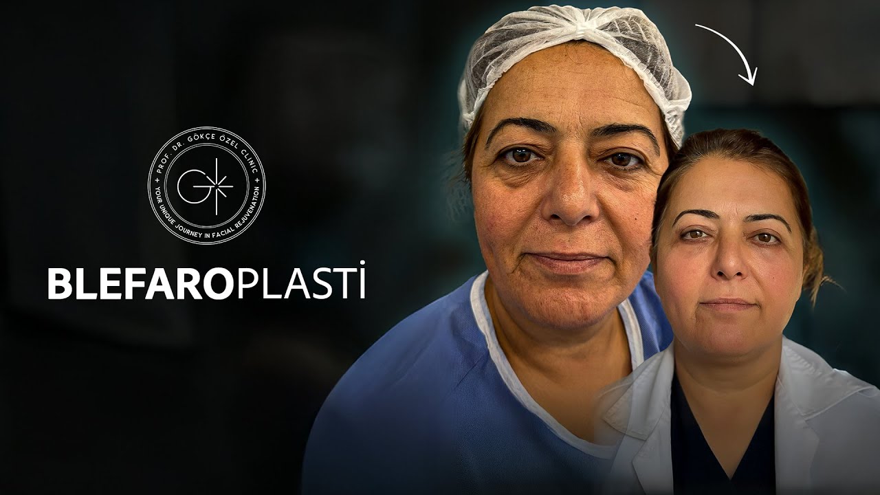 CANLI CERRAHİ GÖZ ESTETİĞİ UYGULAMAMIZ #gözkapağıestetiği #gözaltıestetiği #gözkapağıameliyatı