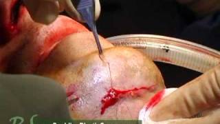 Male neck rejuvenation surgery