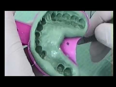 DEMONSTRATIE   Amprenta de arcada in 2 timpi pe fantoma   As  Dr  Dragos Smarandescu 1