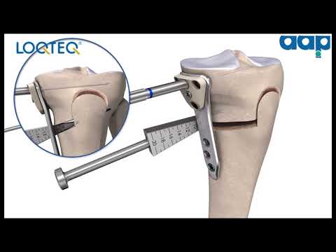 LOQTEQ® High Tibia Osteotomy 4.5 - Surgical Technique