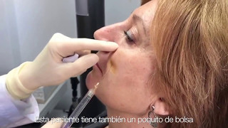 Correccion ojera con ácido hialurónico Dra. Estrella Fernández Palma de Mallorca