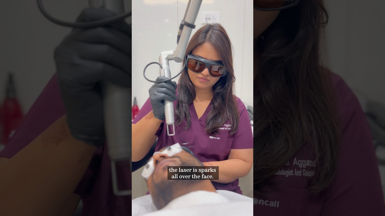 Carbon Laser Peel Treatment #carbonlaserpeel #lasertreatment #skincare #shorts