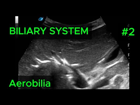 Aerobilia (Pneumobilia) video preview