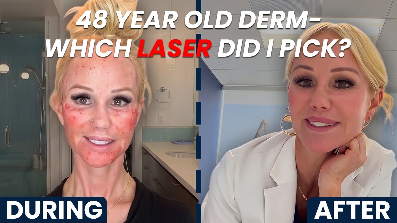 ProFractional Laser Vlog: My Firsthand Experience as a Dermatologist