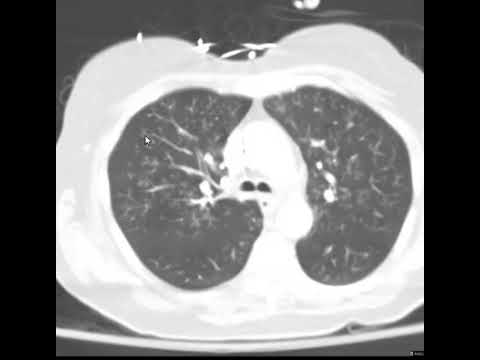 Bronquiolite por Haemophilus influenzae