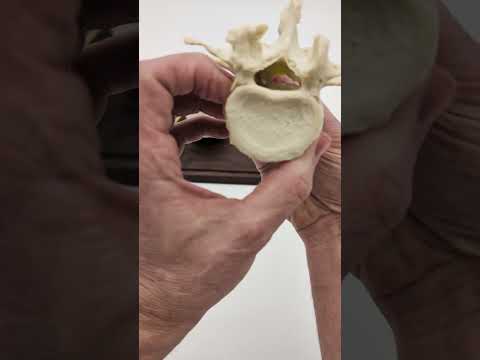 Lumbar Spinal Stenosis in Motion | Central, Lateral & Lateral Recess Stenosis