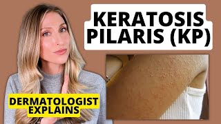 Dermatologist Explains Keratosis Pilaris (KP): Affordable Drugstore Treatments to Try!