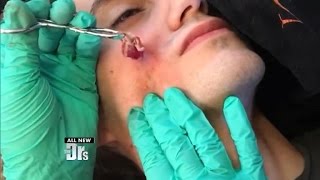 Cyst Excision: Don’t Try This At Home!