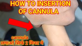 How to insert a cannula ?, वीगो कैसे लगाए, cannula लगाने का सही तरीका 