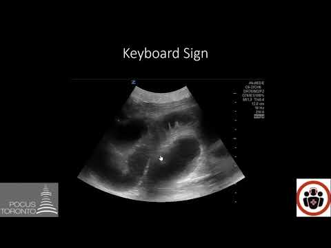 POCUS Cases 5: Small Bowel Obstruction