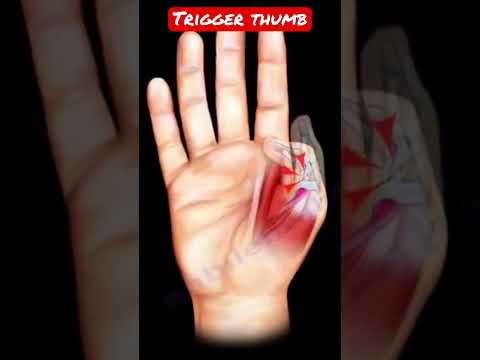 Trigger thumb #shorts