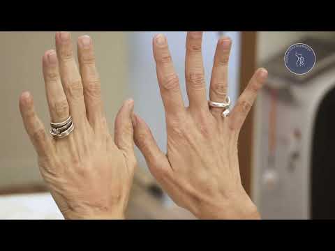 Tratamiento para Manos con Fillmed