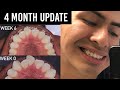 I Got Braces At 26 | 4 Month Update + Day In the Life | Ep. 3