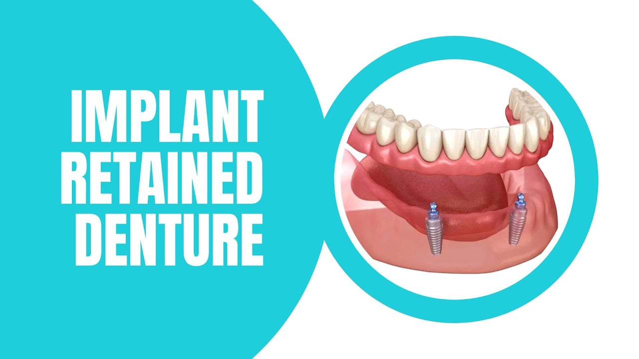 What you should know about implant retained denture! Tooth replacement options explained.