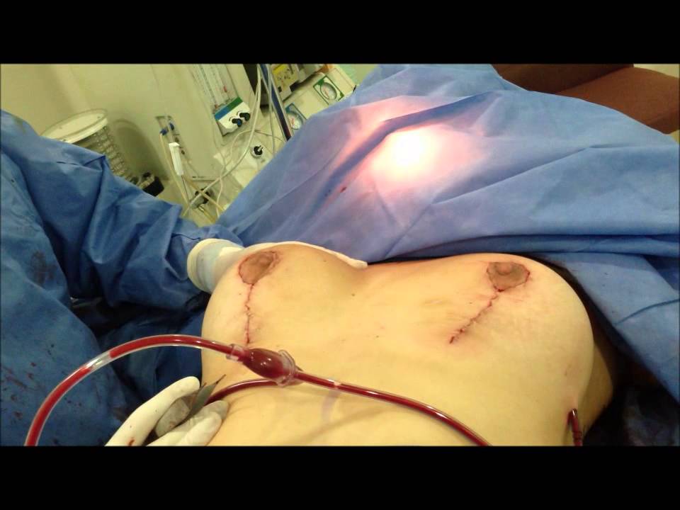 Dr. Carlos Valdivieso Mastopexia sin protesis Final