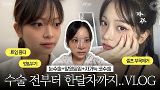 수술 고민중이라면? 필수시청! 눈코수술 VLOG (+셀프 부목제거)