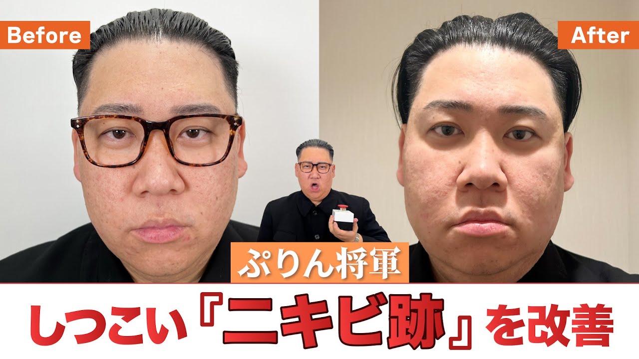 【ぷりん将軍】半年かけて肌荒れ・ニキビ跡の治療をしました！