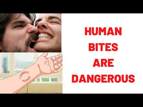 HUMAN BITES ARE DANGEROUS: Human Bites What To Do? : Human Bites Treatment- Symptoms- Complications