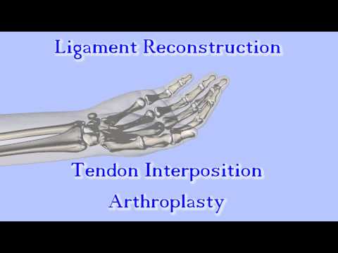 The Anchovy Procedure for Thumb Basal Joint Arthritis