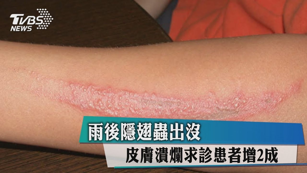 雨後隱翅蟲出沒　皮膚潰爛求診患者增2成