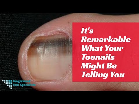 It's Remarkable What Your Toenails Might Be Telling You