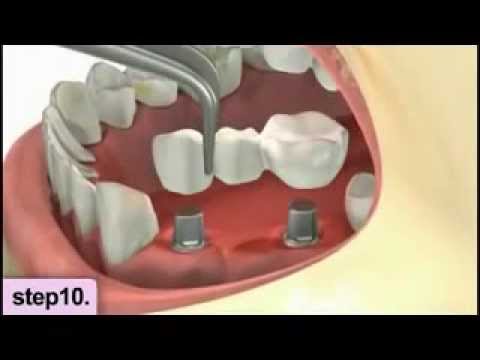 dental hospital in delhi | dental implant clinic | dental treatment in delhi