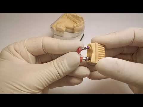 Zahntechnischer Workflow - Bicon: Teil 6 Positionierungsschlüssel