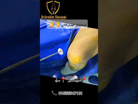 نجاح عملية استئصال اورام الركبة بالمنظار مع دكتور ابراهيم شعراوي