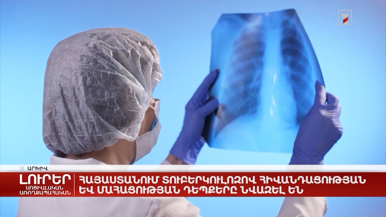 Հայաստանում տուբերկուլոզով հիվանդացության և մահացության դեպքերը նվազել են