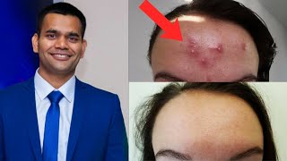 Get Rid Of Forehead Acne Naturally in just 7 days | Forehead Acne
