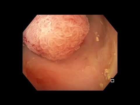 Colonoscopy: Tethered Sigmoid Colon Polyp Resection