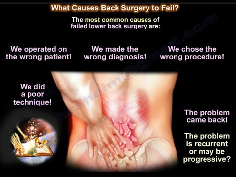 ¿Qué causa el fracaso de la cirugía de la espalda? 