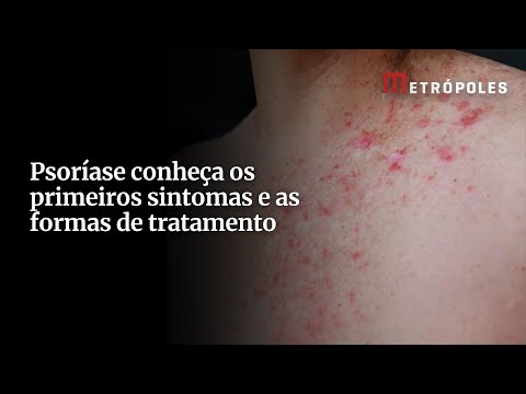 Psoríase conheça os primeiros sintomas e as formas de tratamento