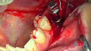 Extraccion de implante con extractor universal MCT