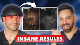 The Truth About Hair Growth Laser LLLT Helmets | Dermatologist Reviews