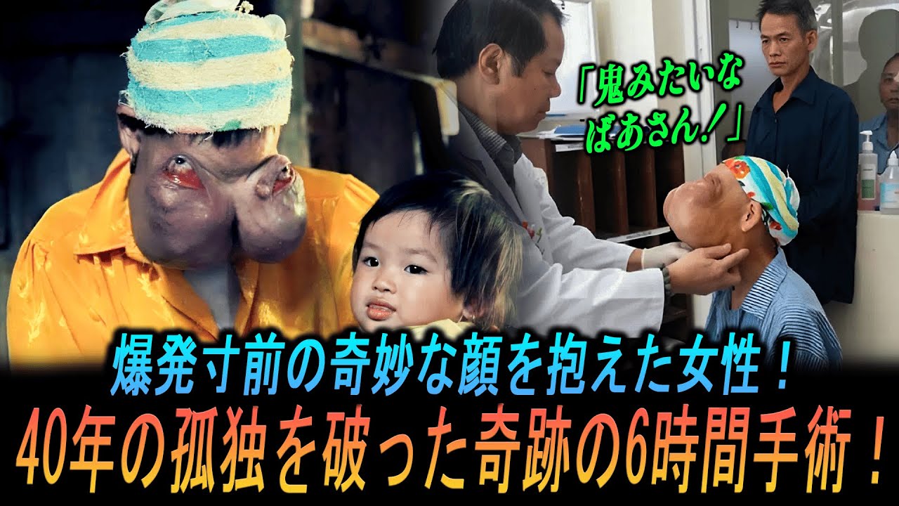 【実話】ベトナムの女性が顔が今にも爆発しそうな奇妙な顔のせいで40年間隠れて生きた！？孤立から6時間に及ぶ生死をかけた手術後の奇跡の旅路！！