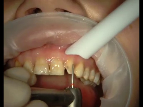 Реставрация зубов, пораженных флюорозом