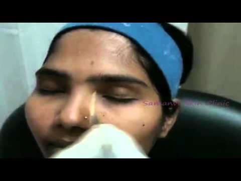 Chemical Peel Samanvi Skin Clinic