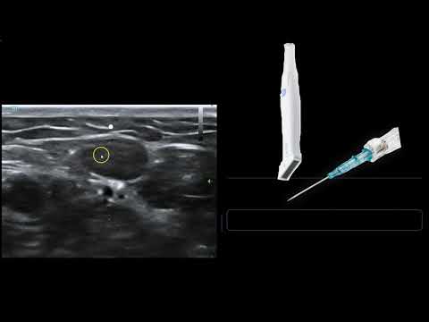 Ultrasound Guided IV Access