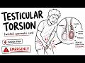 Testicular Torsion – Pathophysiology, Presentation, and Emergency Management
