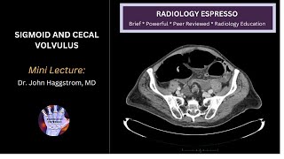 SIGMOID AND CECAL VOLVULUS: Mini Lecture, Dr. John Haggstrom, MD
