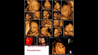 How To Get Perfect 3D/4D Baby Image By Ultrasonography System ( by Mindray )